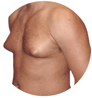 Gynecomastia is defined as enlarged glandular (ducting) tissue, especially in male breasts.