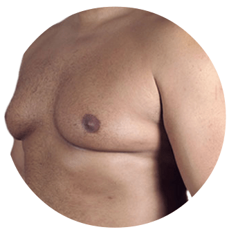 Man boobs are typically areas of excessive pectoral fat in the middle of the breast or chest area on a man.