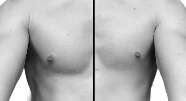 lower chest asymmetry 1