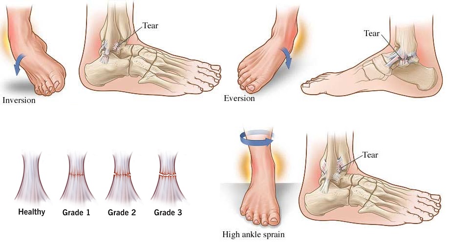 Dealing with an Ankle Sprain: Your Complete Guide 3 How to Diagnose an Ankle Sprain